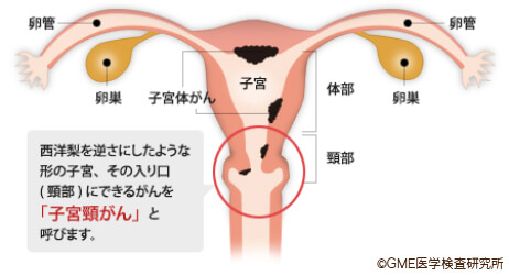 西洋梨を逆さにしたような形の子宮、その入り口(頸部)にできるがんを「子宮頸がん」と呼びます。
