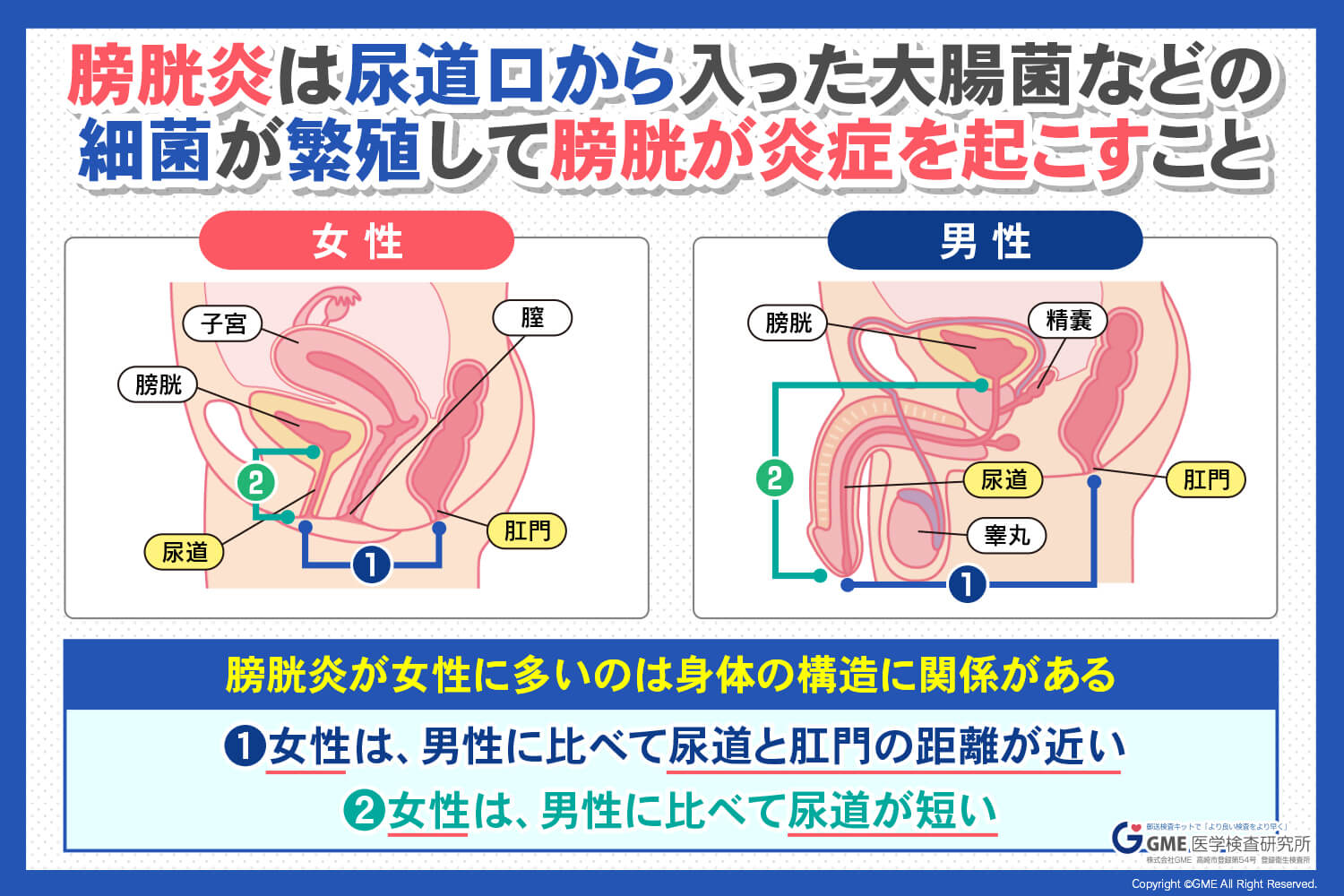 女性に多い【膀胱炎】の原因と対策について | GME医学検査研究所