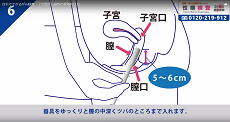 子宮頸がん検査6
