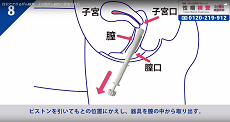 子宮頸がん検査8