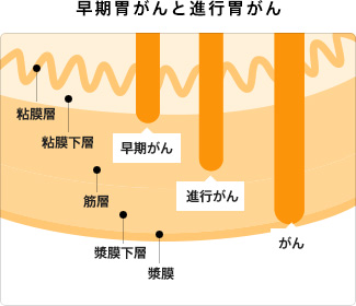 スキルス 性 胃がん と は